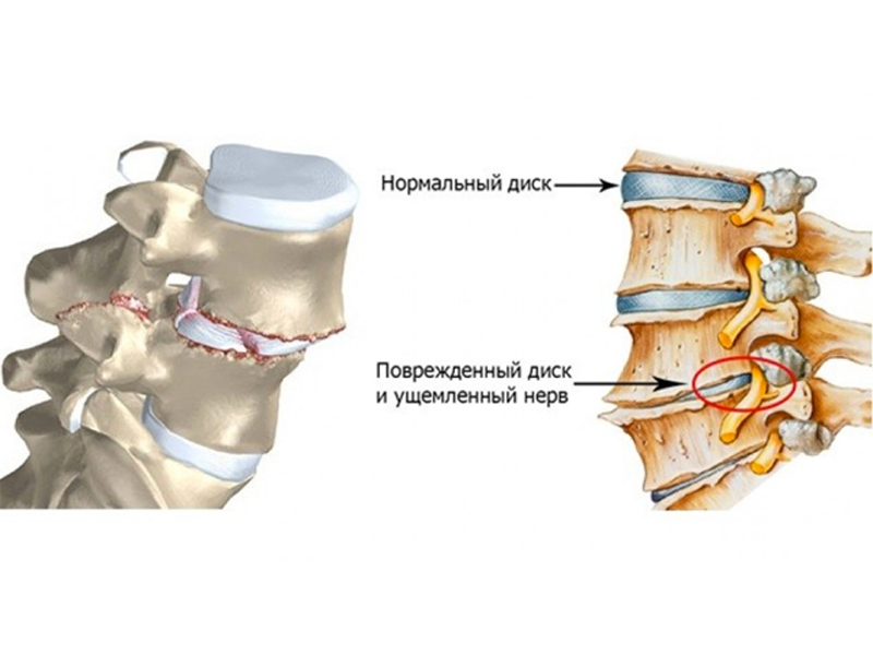 Остеохондроз шейного отдела протрузии
