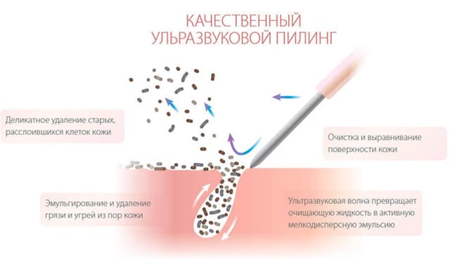 Как выбрать аппарат для ультразвуковой чистки лица